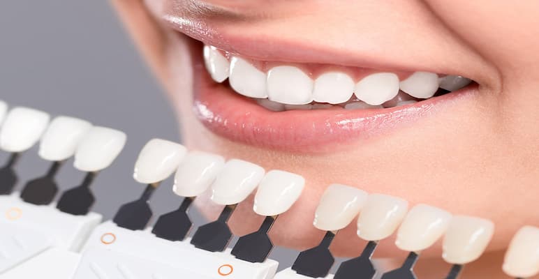 Bọc răng sứ màu nào tự nhiên